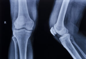 broken-bones-injuries