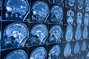 Concussion Injury